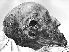 Мумифицированные останки Карла XII; хорошо видно отверстие от пули в голов
